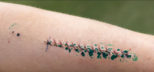 arm-stitches-care