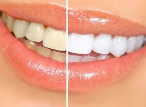 Before and after results of NYC teeth whitening by local dentist