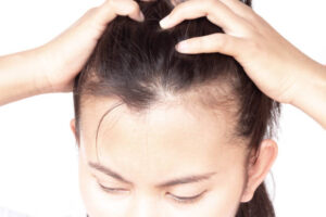 hair loss