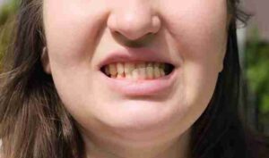 Injured Tooth After a Fall? Here's the Immediate Next Step in Luton