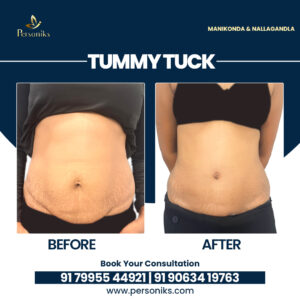 Tummy Tuck After Pregnancy: Restore Your Pre-Baby Body at Top Plastic Surgery Clinic
