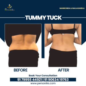 Am I a Good Candidate for Tummy Tuck? Expert Guide from Hyderabad Cosmetic Surgeons
