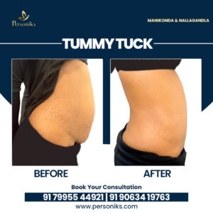 Tummy Tuck After Pregnancy: Restore Your Pre-Baby Body at Top Plastic Surgery Clinic