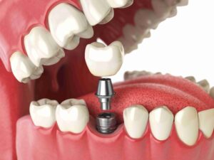 Image Source -Directory dental Liverpool